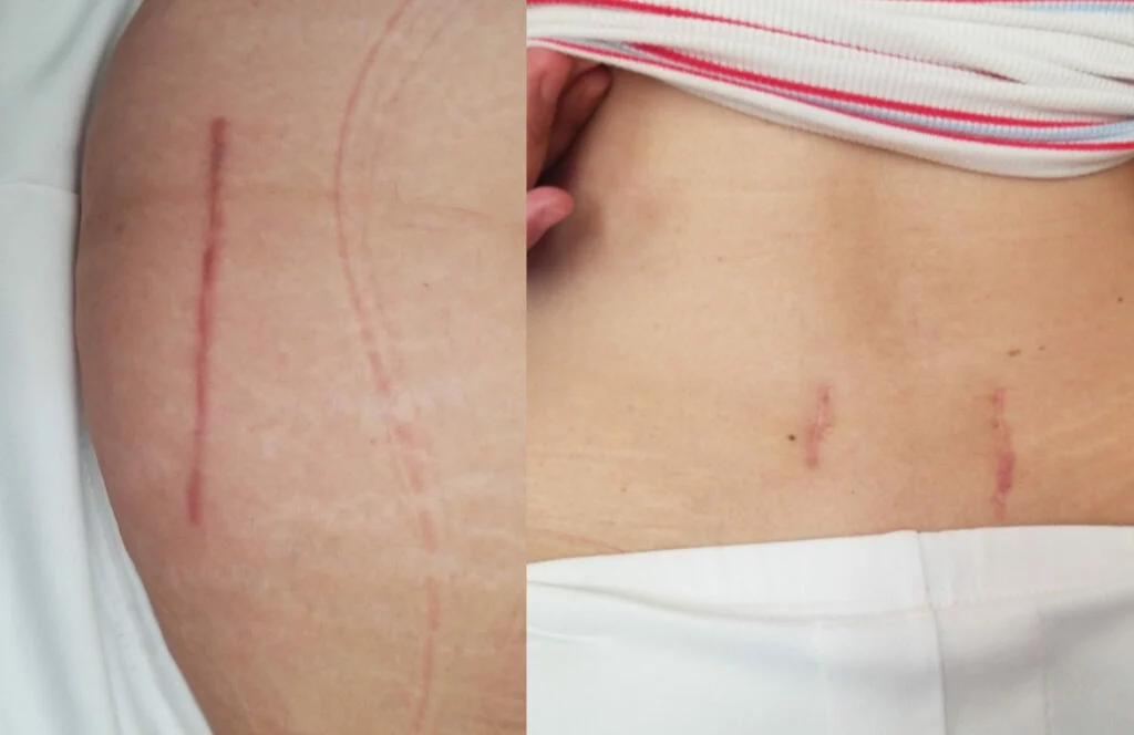 The victim of this rear-end collision was awarded $1.5 m for their injuries.