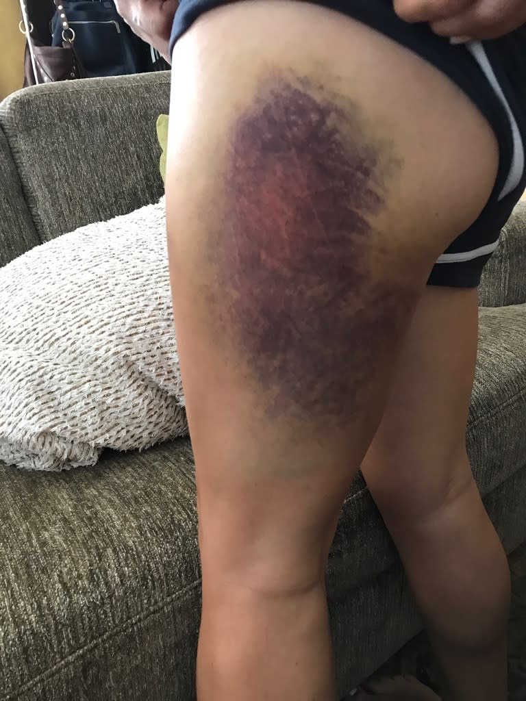 The slip and fall at the water park severely injured the victim's leg.