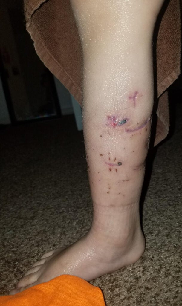 The leg injuries of the dog attack victim after treatment.