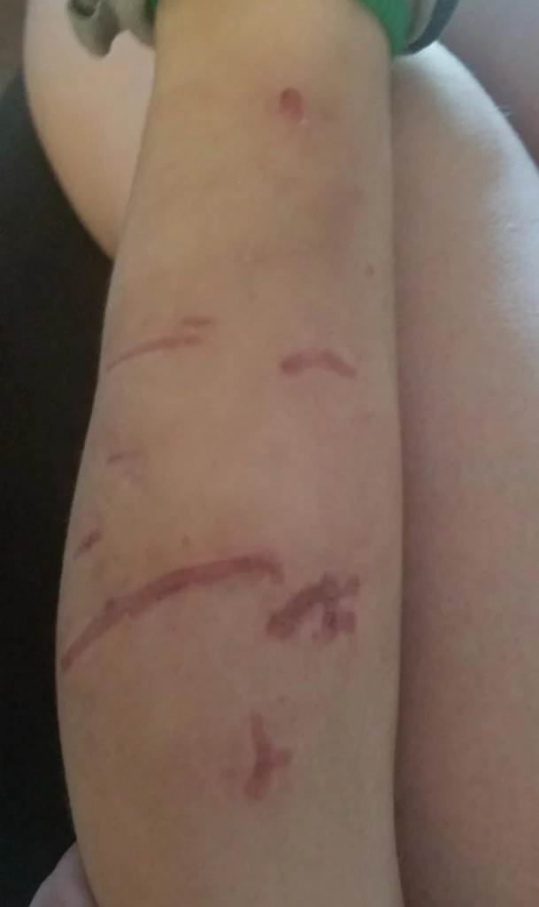 Cicatrices tras la mordedura de perro en la pierna del menor.