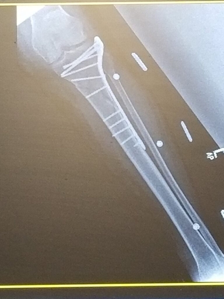 The injuries include a broken bone which required surgery.