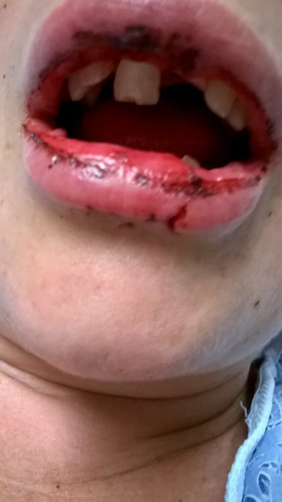 The victim's lips and gums were also severely damaged by the battery explosion.
