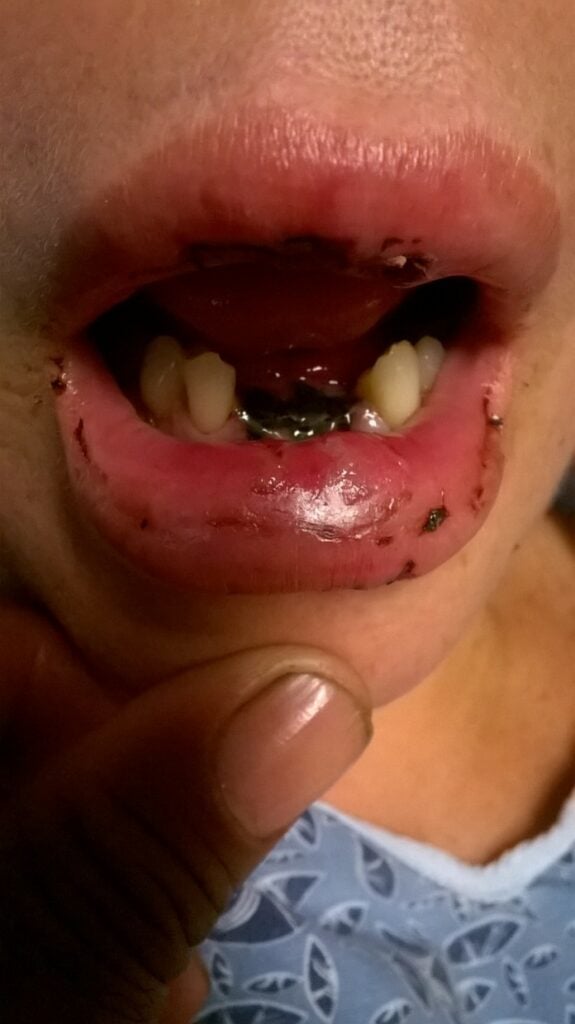 The victim of the vape battery explosion was bleeding from the mouth.