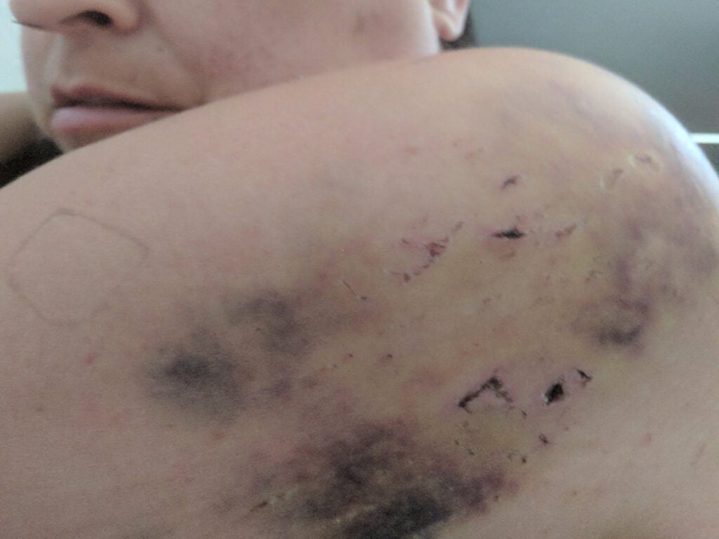 La víctima tuvo que someterse a tratamiento para curar las graves heridas del accidente.