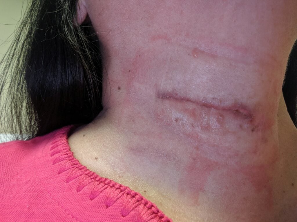 Due to the severity of the accident, our client had to undergo surgery.
