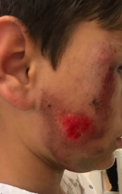 Facial injuries from bicycle accidents can be devastating for children.