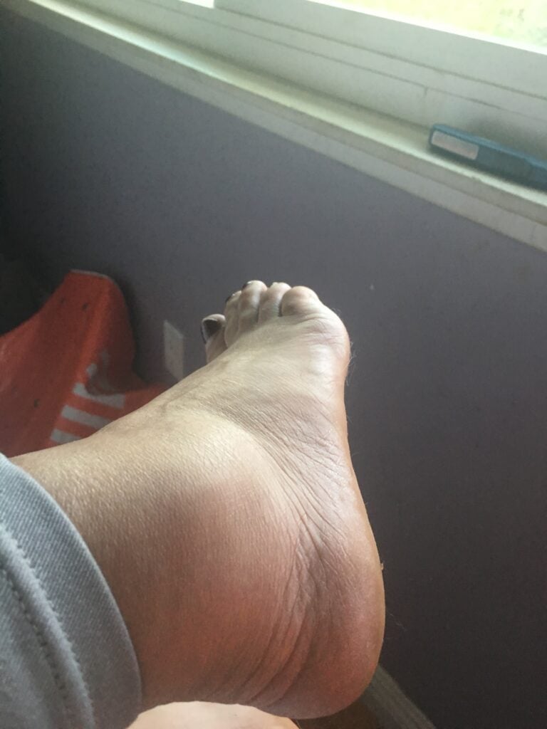 Swollen foot victim of store slip and fall receives $150K settlement.