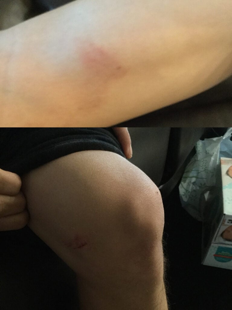 Cuando el camión colisiona con el auto de la víctima, el brutal impacto le lesionó las rodillas.