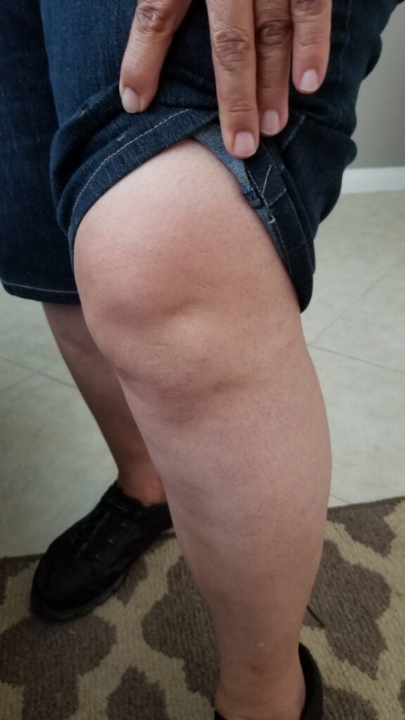 The slip and fall at Panera Bread severely injured the victim's left knee.