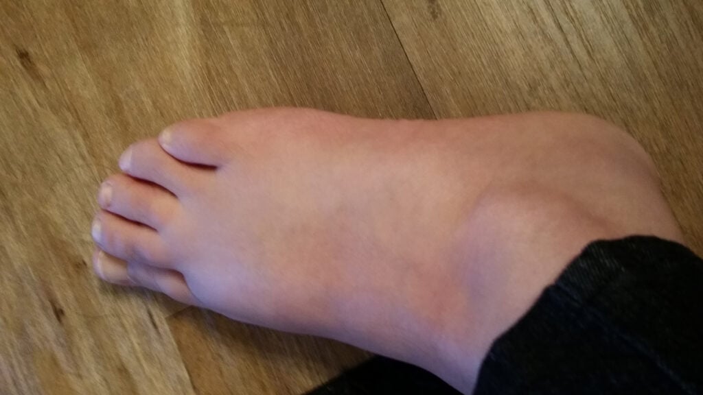 Victim's foot after tripping.