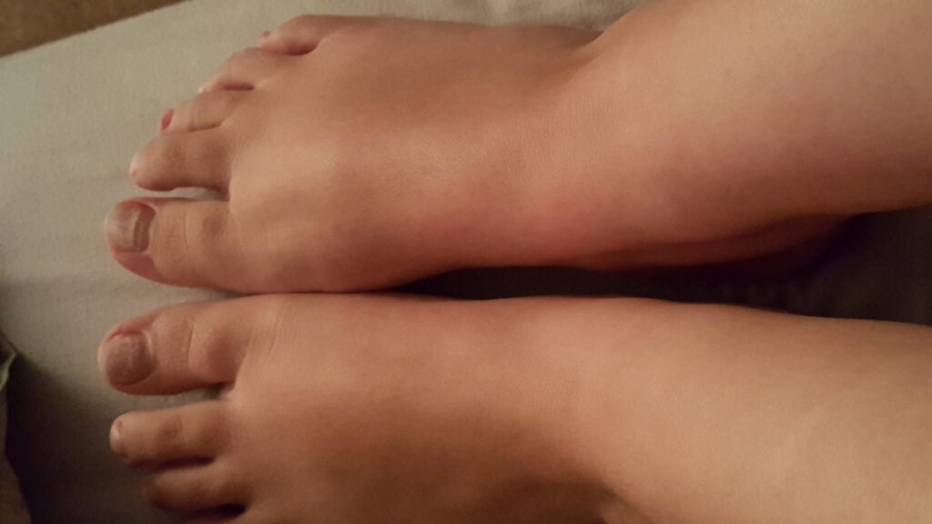Both feet of the victim after the accident.