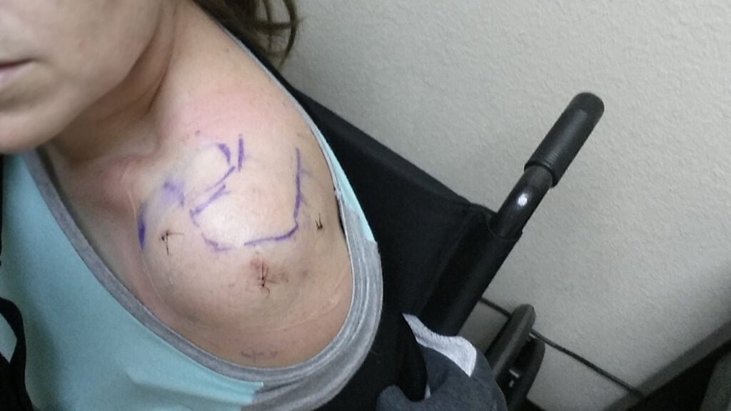 Shoulder injury due to trip and fall