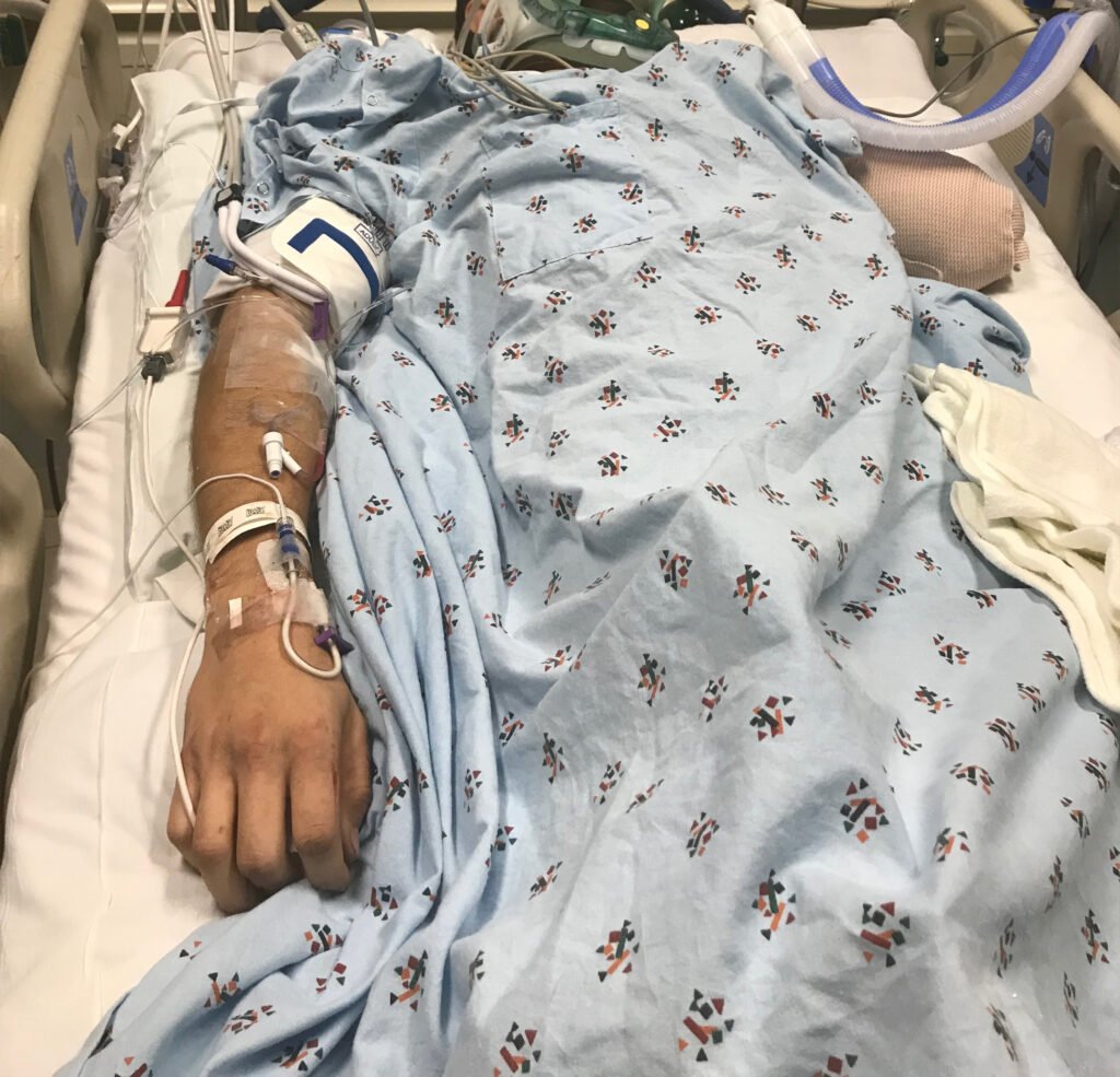 La víctima pasó mucho tiempo recuperándose del brazo desmembrado.