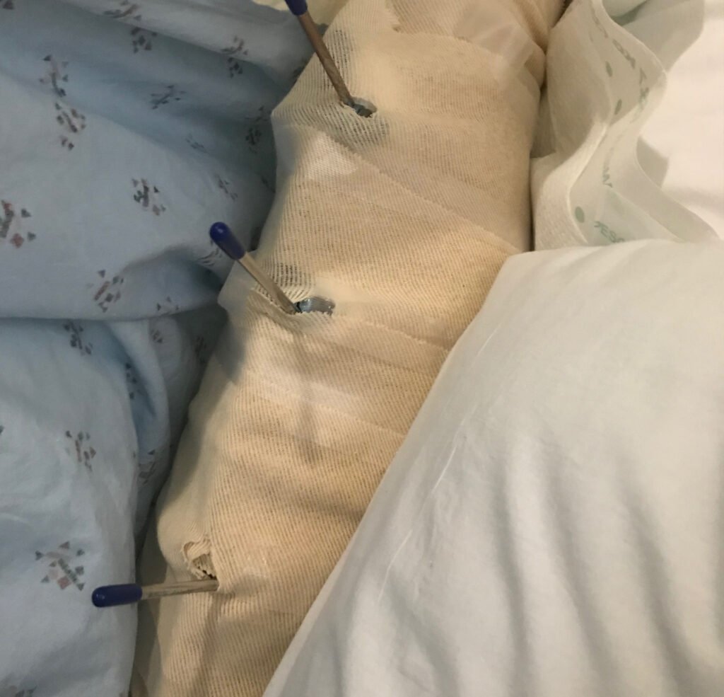 Las graves lesiones sufridas por la víctima en el brazo izquierdo provocaron su amputación.