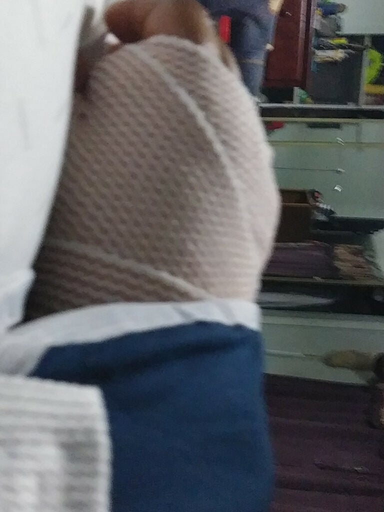 Hand of the victim after the injury caused by the McDonald's employee.