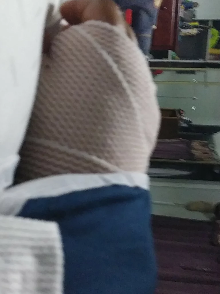 Hand of the victim after the injury caused by the McDonald's employee.