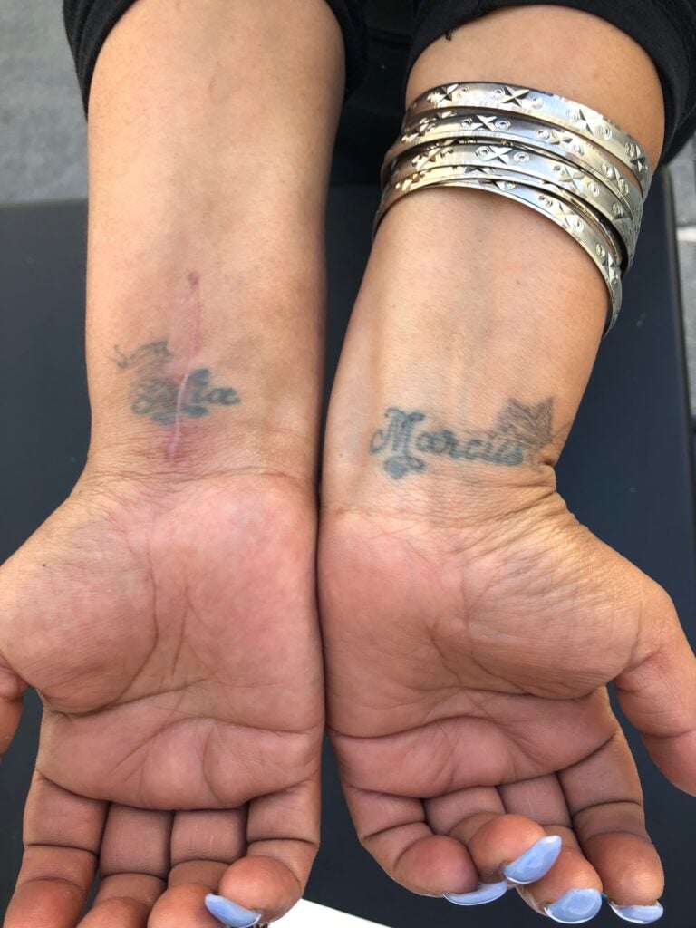 The victim's wrists after recovery from injuries.