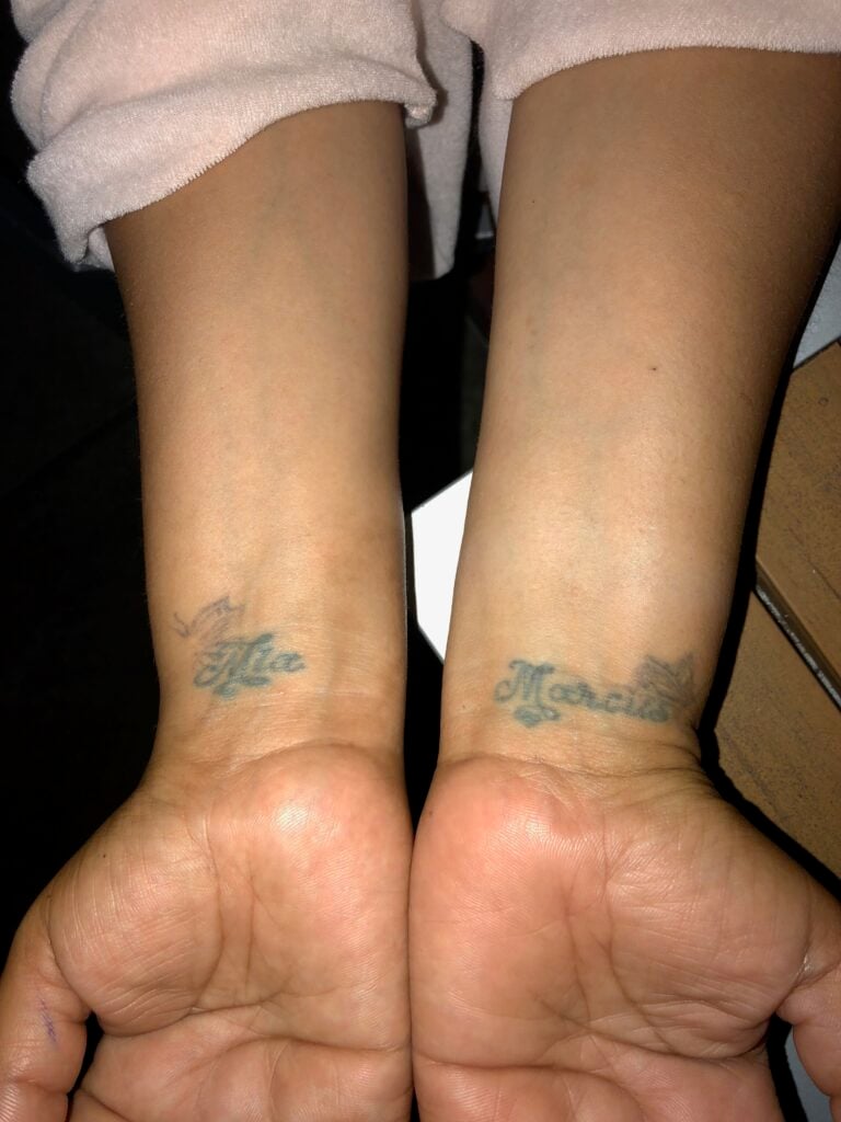 Comparison of the two hands of the victim after the injuries caused by the attack at McDonald's.