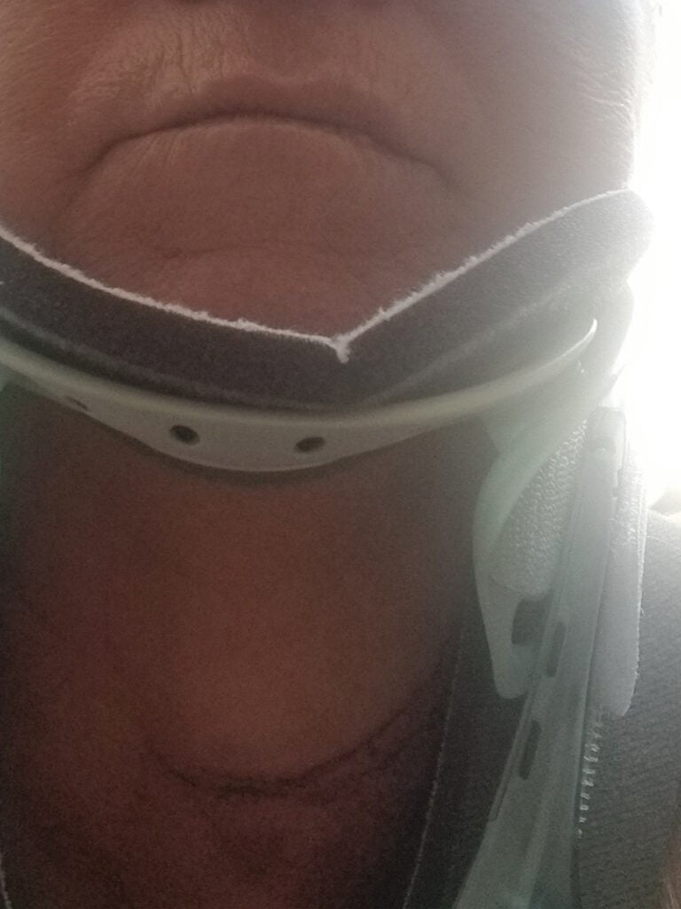 Además de la lesión de hombro por caída, la víctima también sufrió dolores de cuello, columna cervical, y tórax.
