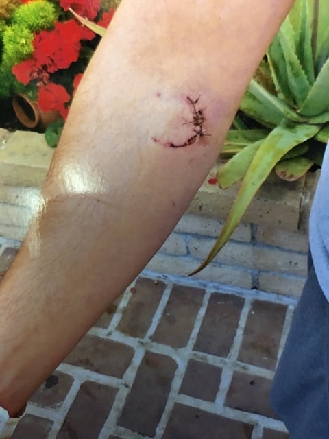 Stab wound caused by bar bouncer security.