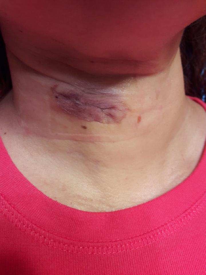 The victim, an Uber passenger in a rear-end crash, had to undergo neck surgery.