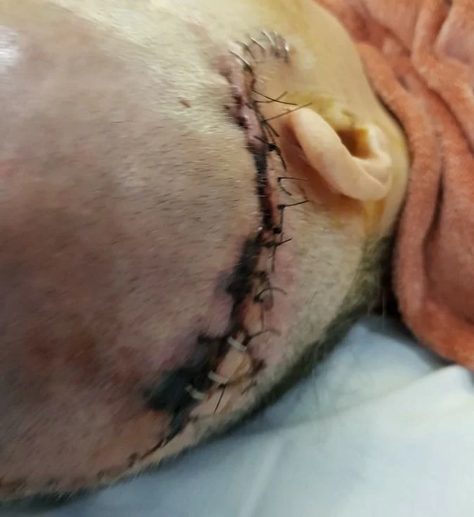 Head after surgery for severe brain damage sustained in a pedestrian accident.