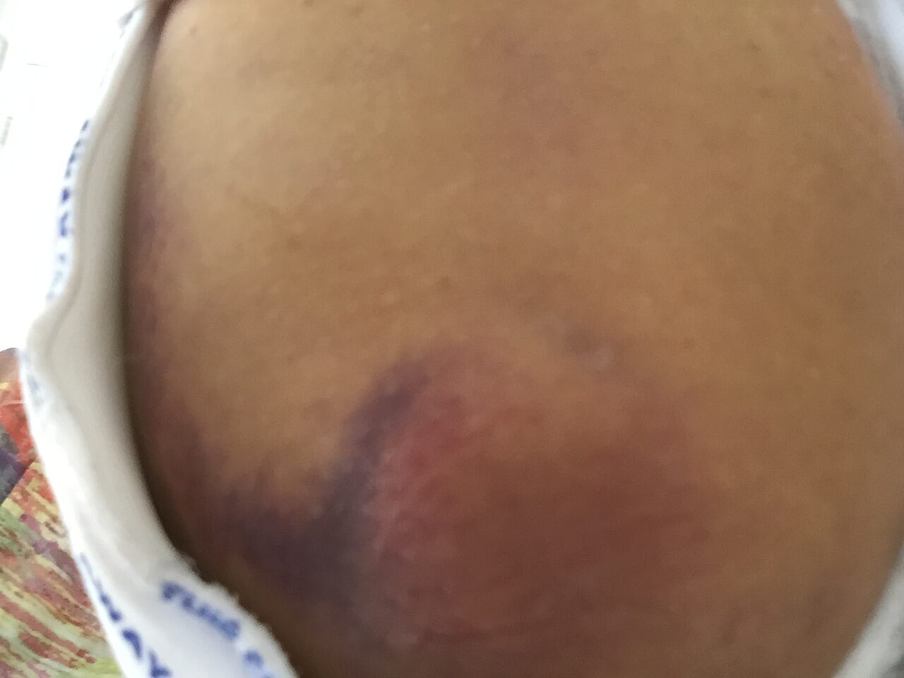 The fall at the gas station caused bruises on their body.