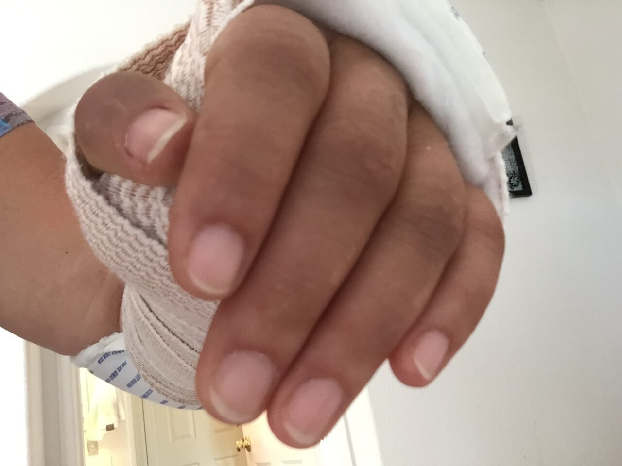 The victim's left wrist was fractured in the fall accident.