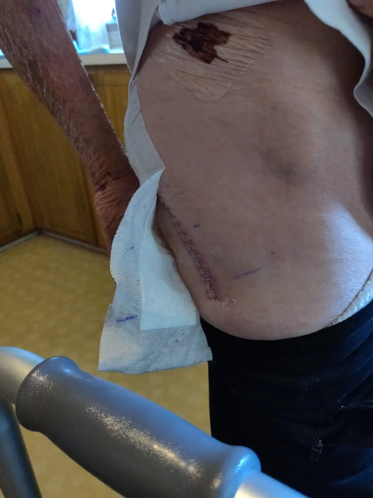 The victim shows the injuries to the upper torso, specifically the hip operation.