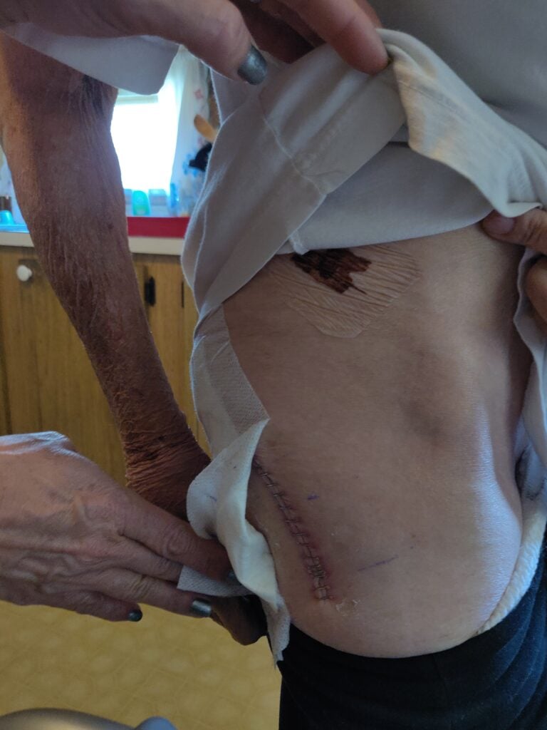 The victim had to require hip surgery after the fall due to the trip.