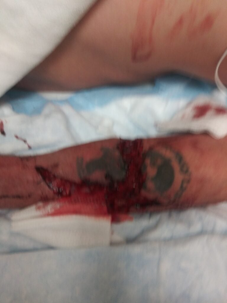 Victim's arm bleeding as he suffered severe injuries from the accident.