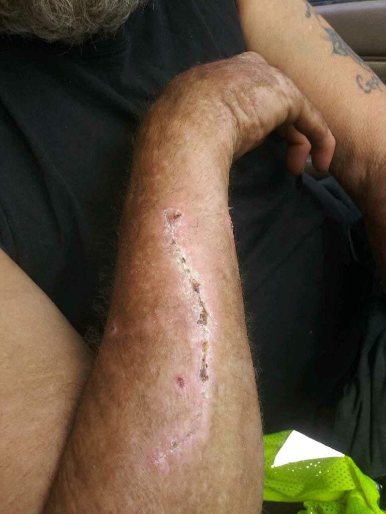 Victim's right hand with side-impact collision wound healing.