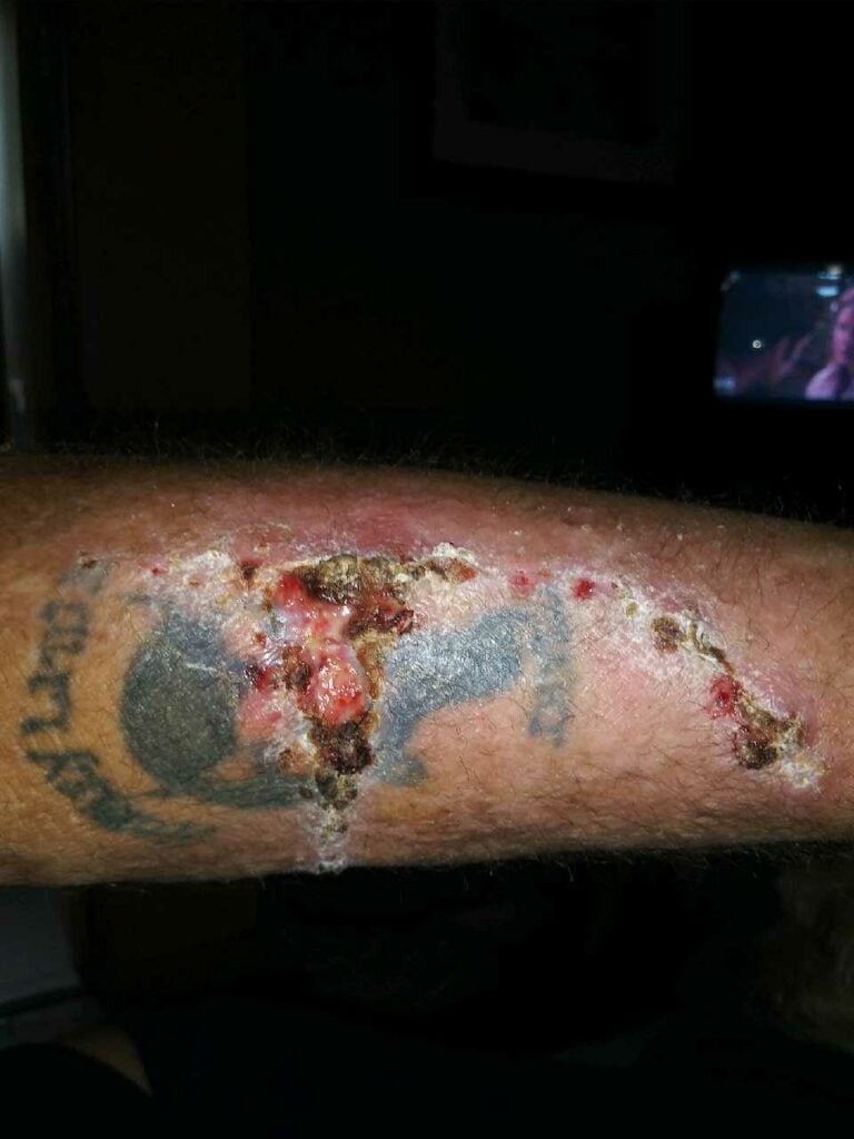 Lateral part of the victim's arm with serious injuries after the collision.