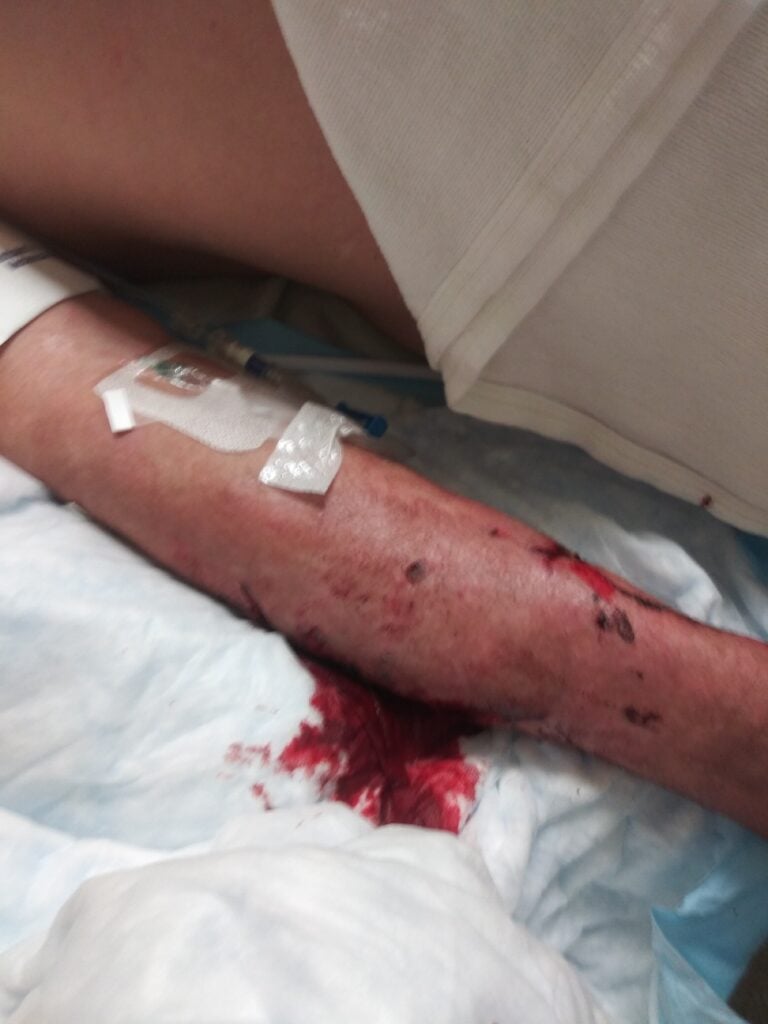 Side-impact collision victim in hospital receiving care for injuries.