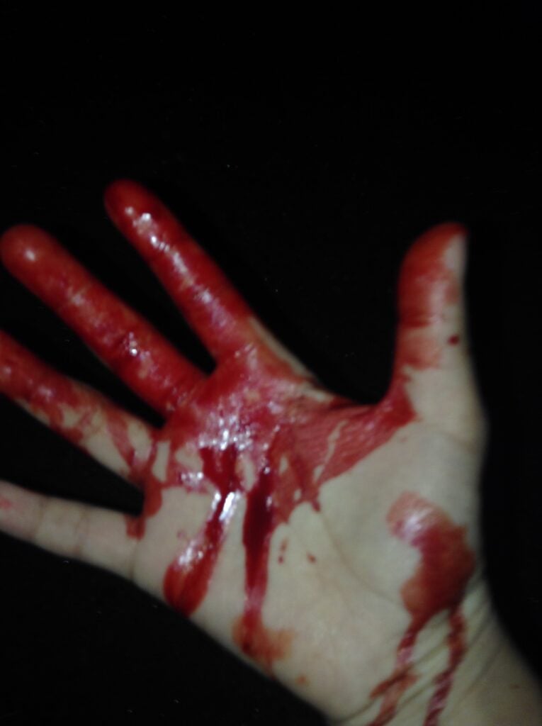Hand full of blood after the accident.