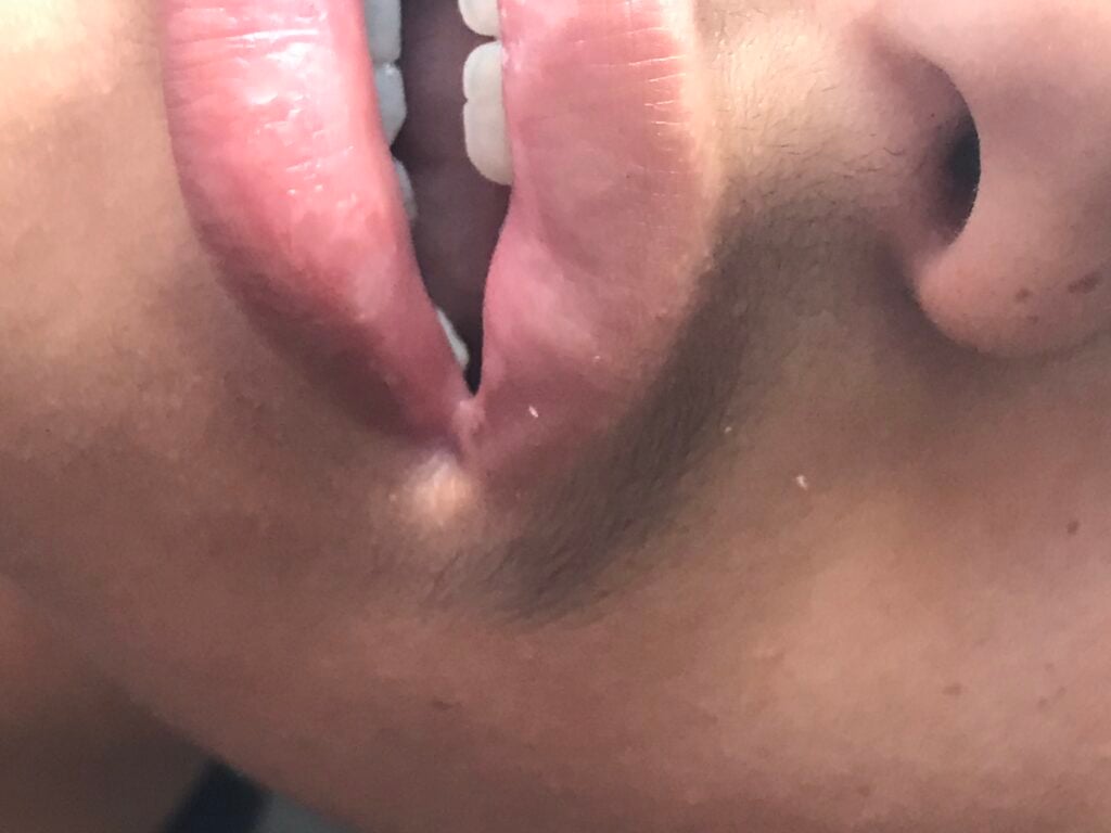 Bleeding mouth of one of the victims of the rear end collision.