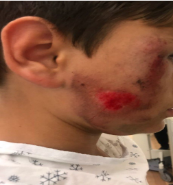 Minor victim shows facial injuries from the bike accident.