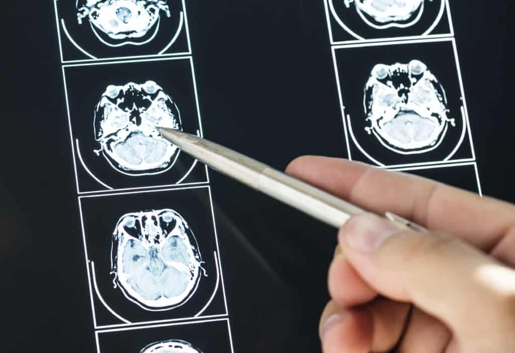 Brain x-ray after medical malpractice resulting in a blow to the head.