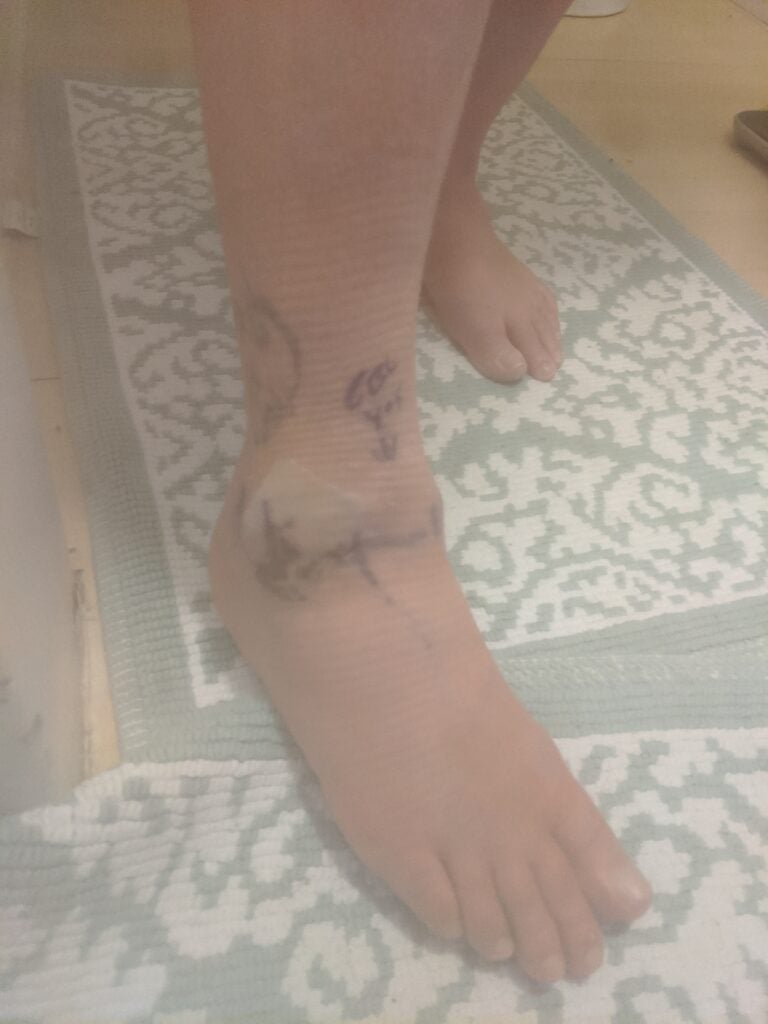 Victim's personal injury from tripping on the deck.