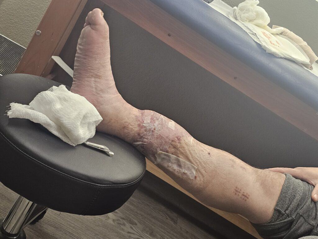Broken and deformed leg from the machinery accident.