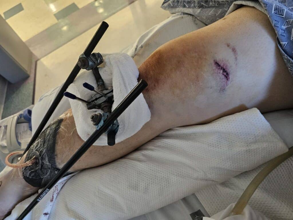 A broken leg displayed over a hospital bed with medical equipment for treatment