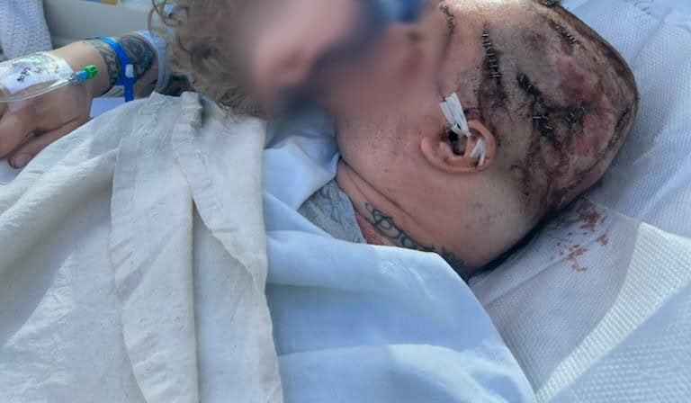 The machine accident victim with 70 stitches in the head lying on a bed.