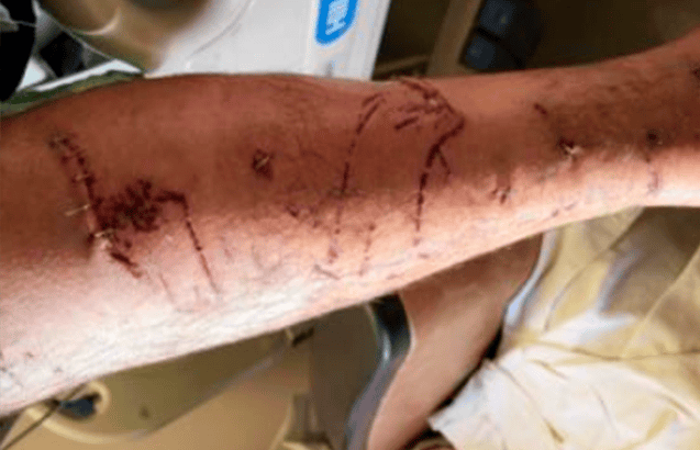 Stitch scars on the victim's leg from the dog bite.