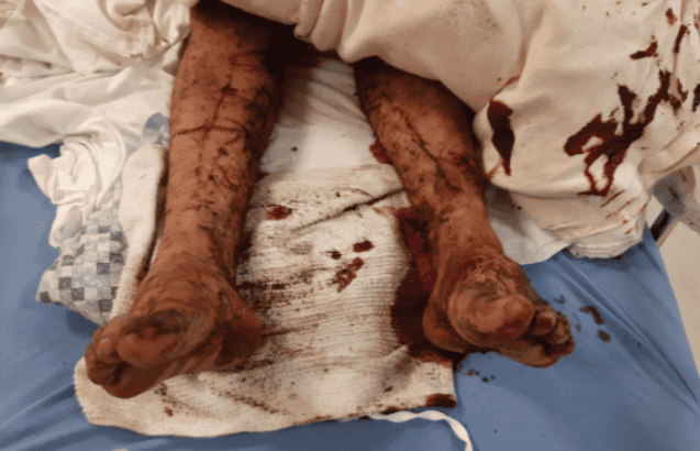 $1M Settlement for Dog Attack Victim in Visalia