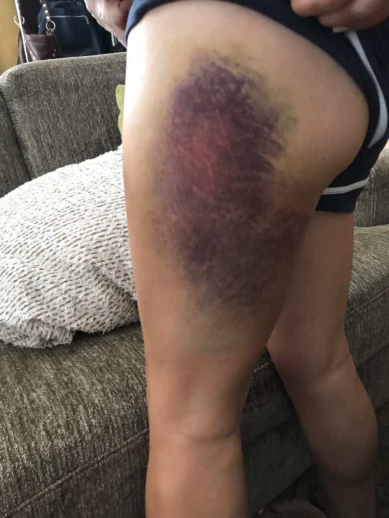$250K Negotiated Settlement for a Water Park Accident