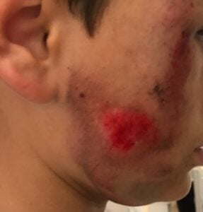 Underage client of AA Law injured in a bicycle accident.