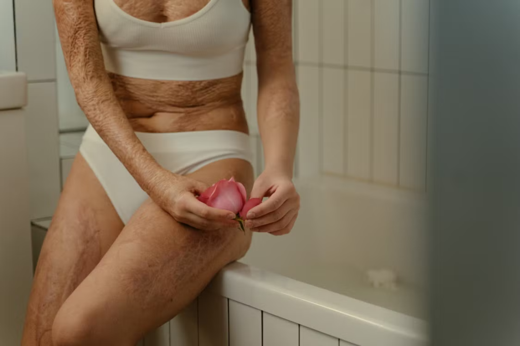 Wildfire burn injury survivor coping with permanent scars and the effects of severe burns